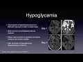 Dr Valesky Approach to Stroke Code