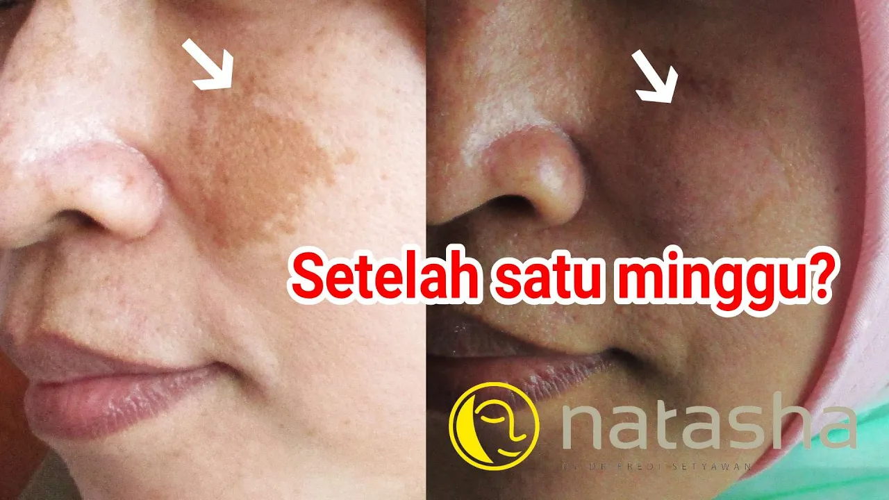 Harga Laser CO2 Natasha Skincare | Simak Full Agar Tidak Gagal Paham. 