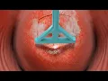 Loop Electrosurgical Excision Procedure LEEP 3D Animation