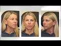 Testimonial - Brow Lift Upper and Lower Blepharoplasty and CO2 Laser Skin Resurfacing