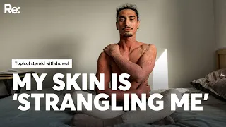Eczema Why do we know so little about topical steroid wit rawal