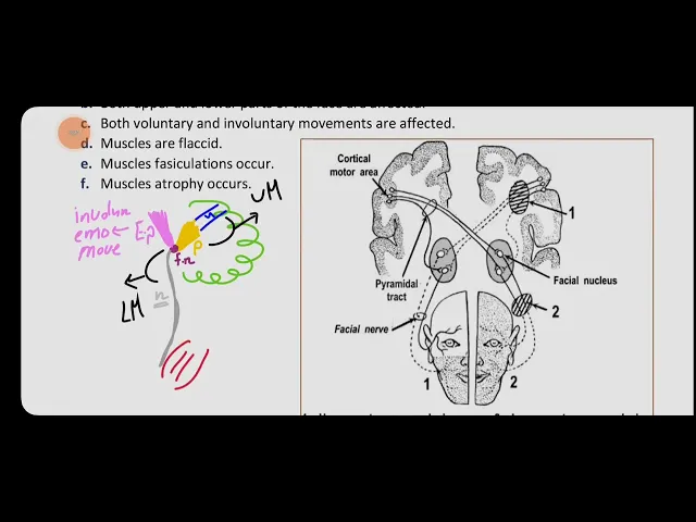 Chapter 8 : Facial Nerve Paralysis ( ENT )
