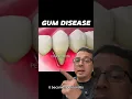 Download Lagu Understanding the Stages of Periodontal Disease | In Office to Hands On Dental Training #shorts