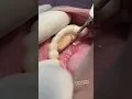 Scaling of tartar calculus from teeth