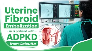 Uterine Fibroid Embolization in a patient with ADPKD from Calcutta.