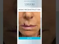 A Delicate Repair Near the Upper Lip Dr Yamasaki