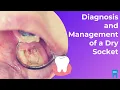 What is a Dry Socket Diagnosis and Management
