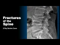 Fractures of the Spine X-Ray Cases
