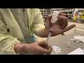 Negative Pressure Technique
