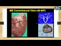 Transesophageal Echocardiographic views for MitraClip - Plus Suitability Reference Guide