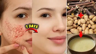 Clear Skin in 7 Days | Remove Dark Spots, Pigmentation, Acne Scars | Home Remedy that Actually Works