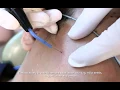 Electrocautery