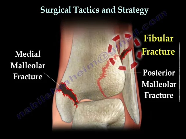 Ankle fracture / Fractures and its repair- Everything You Need To Know - Dr. Nabil Ebraheim