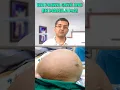Download Lagu Largest fibroid found in a human female | Fibroid treatment without surgery | Dr. Gaurav Gangwani