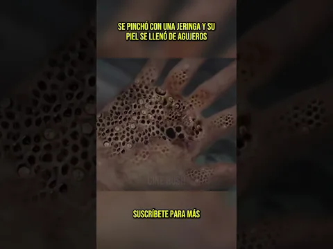 😨 Se pinchó con una jeringa y su piel se llenó de agujeros #shorts