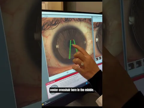 Corneal Topography Demonstration