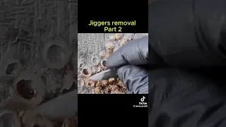 jiggers removal