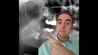 Clarifying Cyst Confusion Cyst vs Dentigerous Cyst