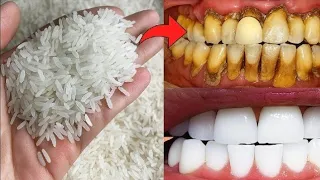 The recipe that dentists are hiding from us🔥!It whitens teeth and eliminates tartar.