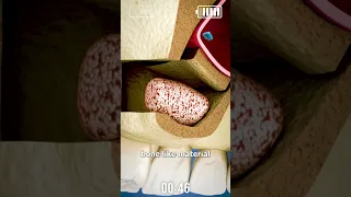  توضیح ساده و کامل جراحی لیفت سینوس   ویدیوی کوتاه          جراحی سینوس  ایمپلنت دندان  سینوس لیفت دندنها