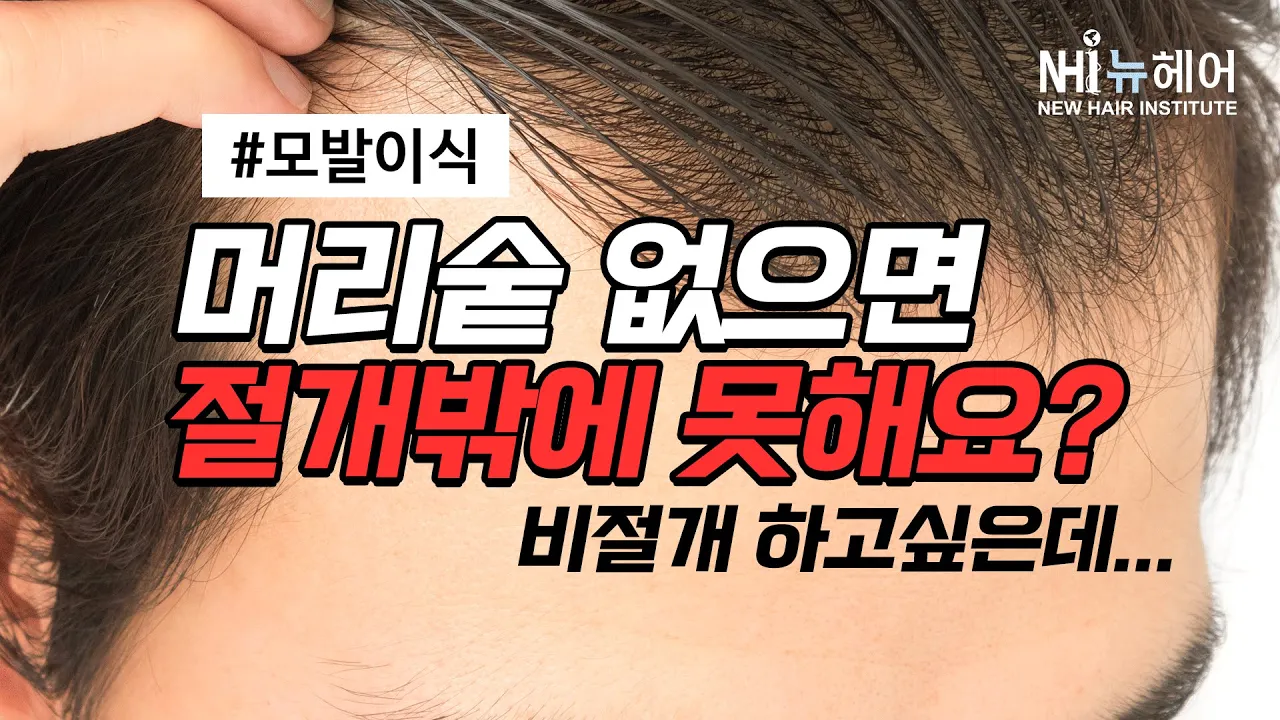머리숱 없으면 모발이식 비절개로 못해요?ㅣ뉴헤어 [모발이식][모발이식후기]