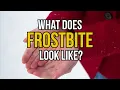 Lagu What does frostbite look like?
