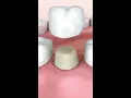 dental crown procedure