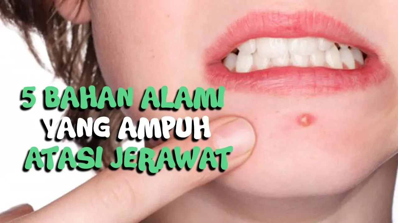 
          
          
          
            
            Jerawat Menganggu Penampilan? Ini 5 Bahan Alami yang Bisa Ampuh Atasi Jerawatmu
          
        . 