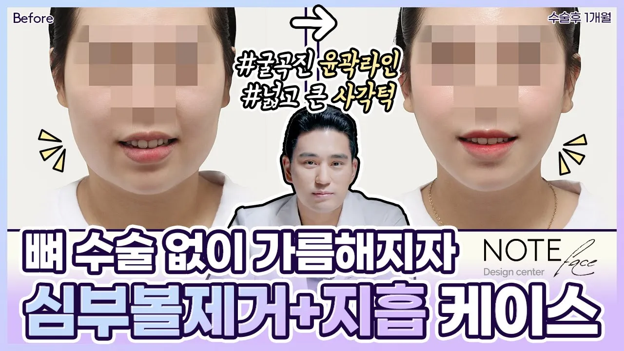 [유.케.리] 📍 CT로 보는 케이스 리뷰 l 얼굴 지방흡입 + 심부볼 제거 l