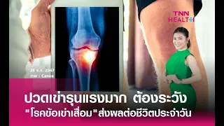 การรักษาโรคข้อเข่าเสื่อมมีวิธีใดบ้าง