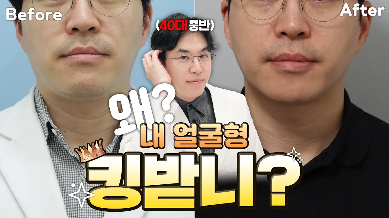 리프팅 레이저 시술 추천! 지금까지 받은 얼굴형 관리 시술 다 알려드림(feat. 울쎄라, 인모드, 올리지오, 슈링크, 슈링크 유니버스) ㅣ 제이필TV