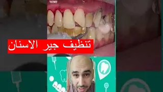 تنظيف جير الأسنان قبل وبعد وأضرار جير الأسنان 
