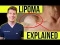 Doctor explains LIPOMA Symptoms clinical photos and treatment