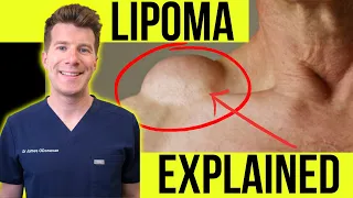 Doctor explains LIPOMA Symptoms clinical photos and treatment