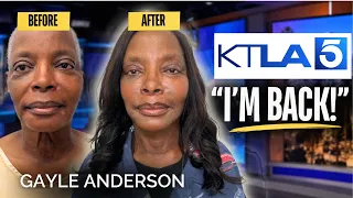 Gayle Anderson’s Facelift Transformation Stunned the KTLA Newsroom