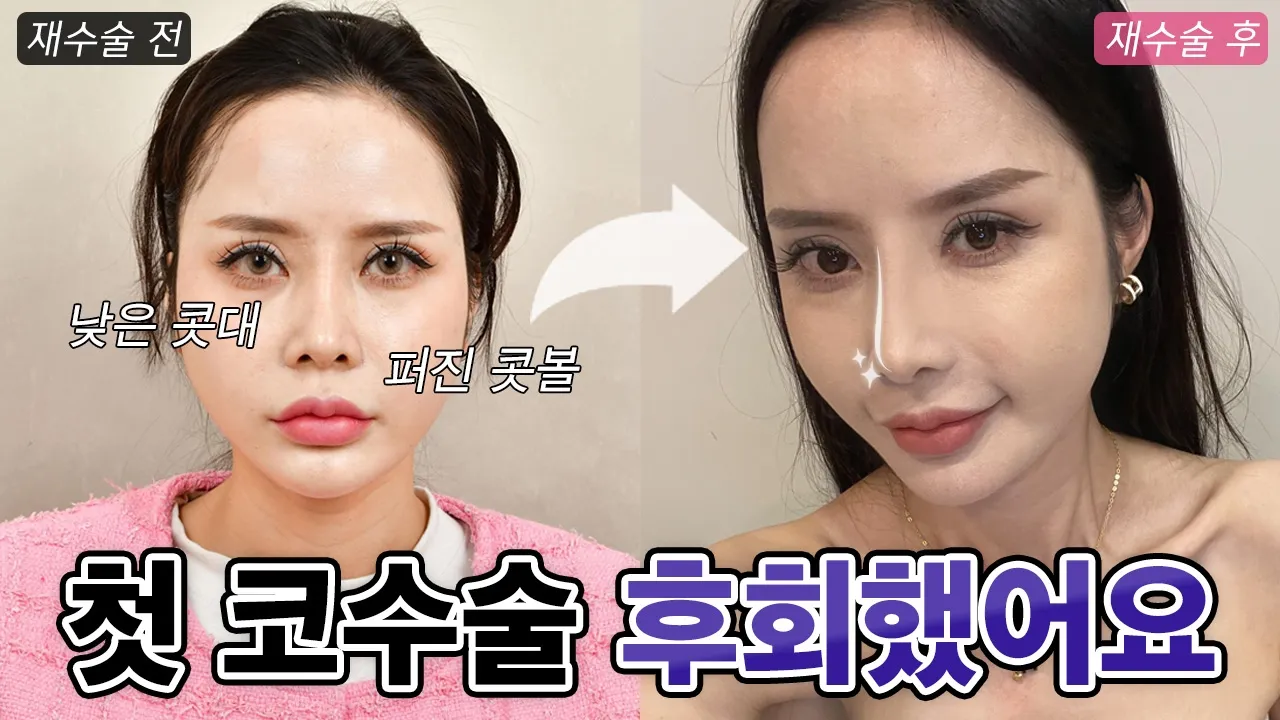 코재수술 전후 공개｜퍼진 콧볼과 낮은 콧대, 이렇게 달라졌습니다