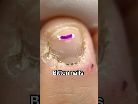 Short bitten Nails recovery ￼