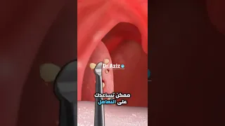 علاج حصى اللوزتين 