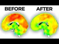 Long-term Effects of Antidepressants on the Brain