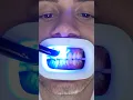 Transformation of Yellow Teeth