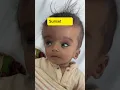 Signs of Hydrocephalus