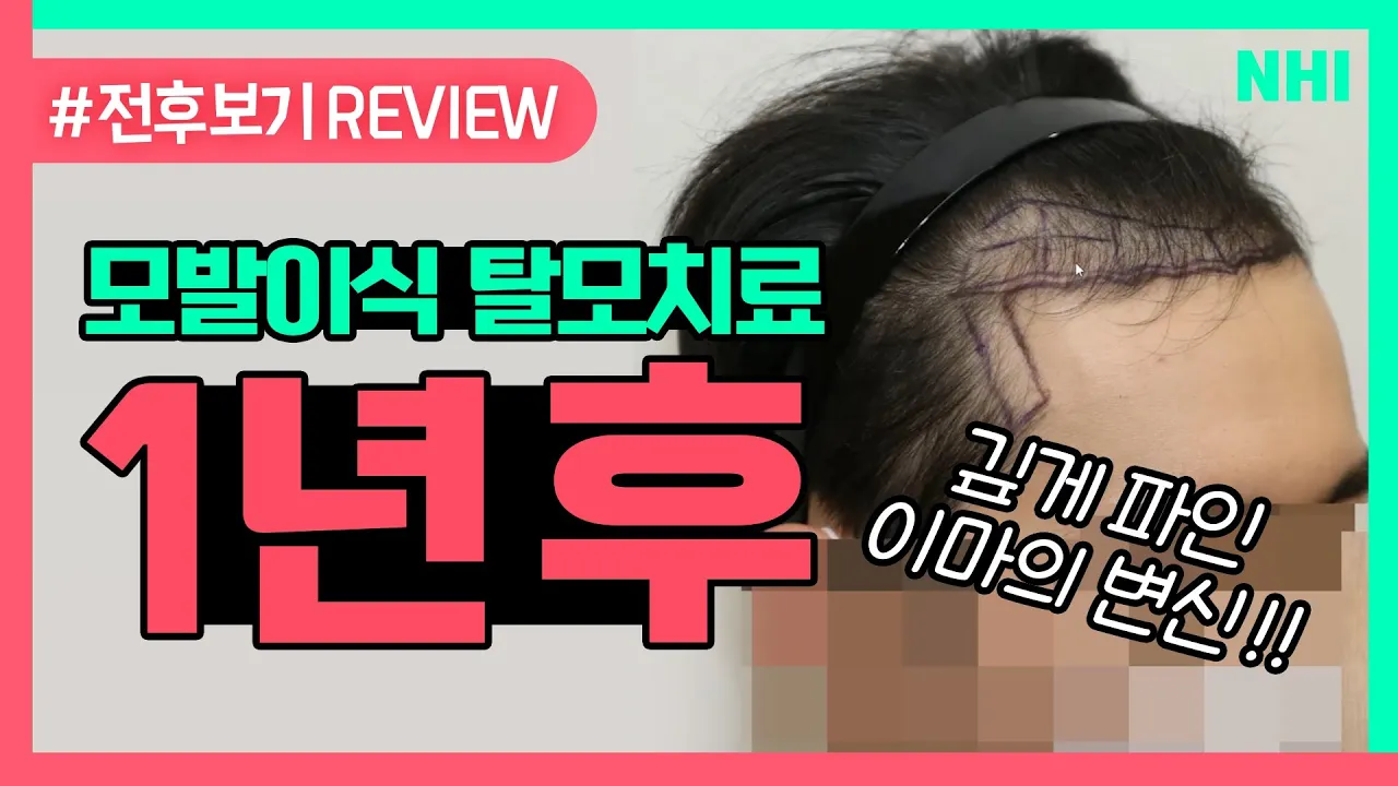 헤어라인교정 모발이식 후 '머리숱이 넘쳐흐름'ㅣ전후보기reviewㅣ뉴헤어