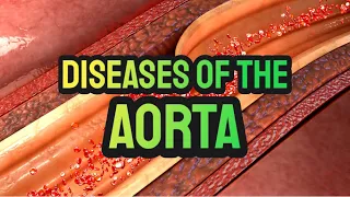 Diseases of the Aorta (updated 2023) - CRASH! Medical Review Series