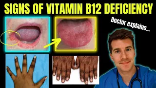 Download Doctor explains clinical signs of Vitamin B12 (cobalamin) deficiency | Glossitis, mouth ulcers etc. MP3