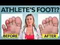 5 Ways to Cure Athlete s Foot That Actually Work