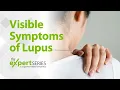 The Expert Series S6E2: Visible Symptoms of Lupus