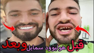 بعد طول إنتظار ساويت عملية هوليوود سمايل في ألمانيا😍🔥