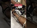 Lagu Limb lengthening surgery | Height increase surgery  #heightsurgery #heightincreasesurgery