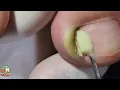 Download Lagu ASMR Ingrown toe Nails extraction