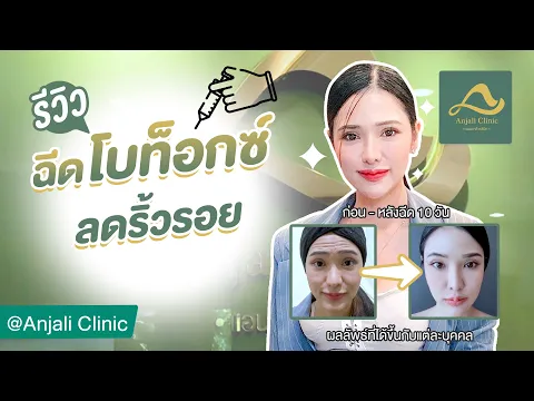 รีวิว ฉีดโบท็อกซ์ ลดริ้วรอย โบท็อกซ์ Aestox ที่ Anjali Clinic | HDreview
